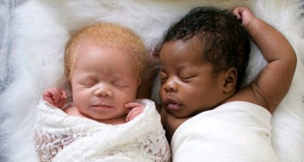 Никой не вярва, че тези красиви деца са близнаци! Историята, която удиви света (Снимки)